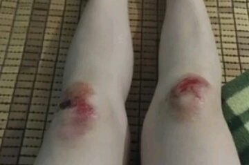 Tuyển chọn 69+ ảnh ngã xe xước tay xước chân tự chụp 